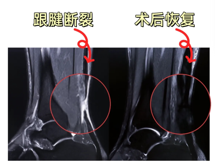 羽毛球场遭遇“运动杀手”，医生：自测后立即就医！